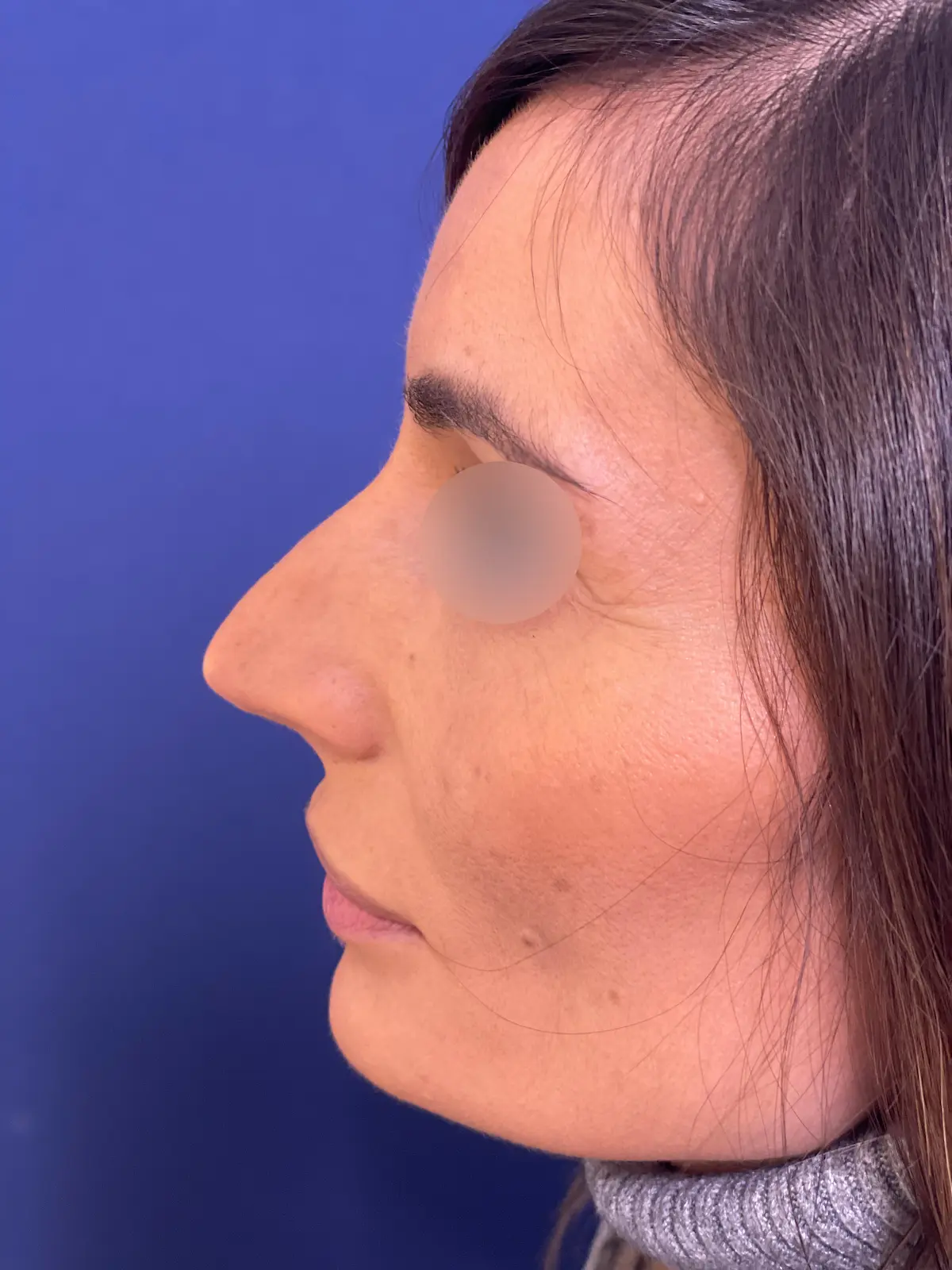 antes rinoplastia