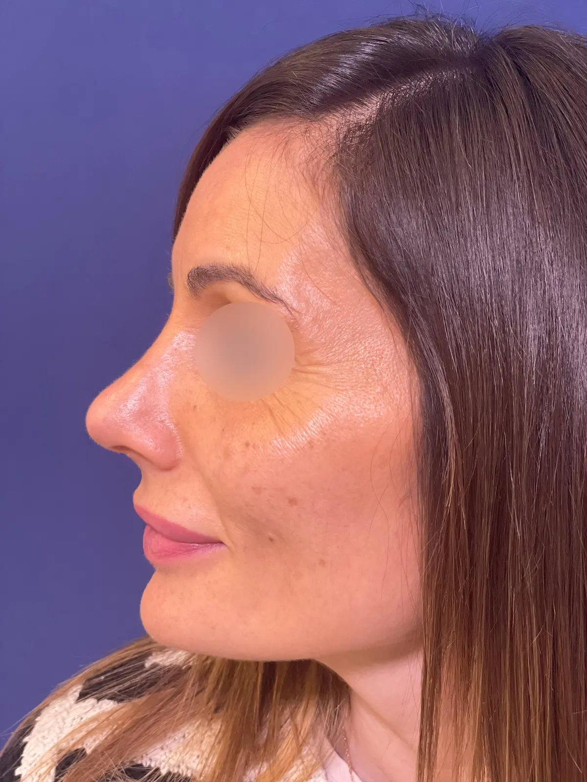 despues rinoplastia