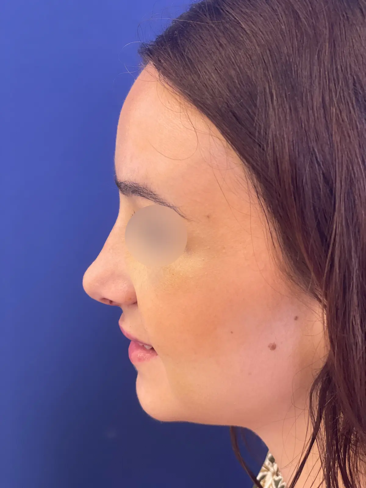 después rinoplastia