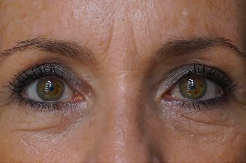 blefaroplastia D