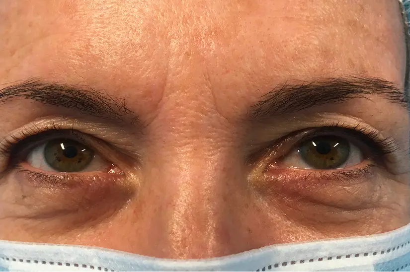 blefaroplastia a