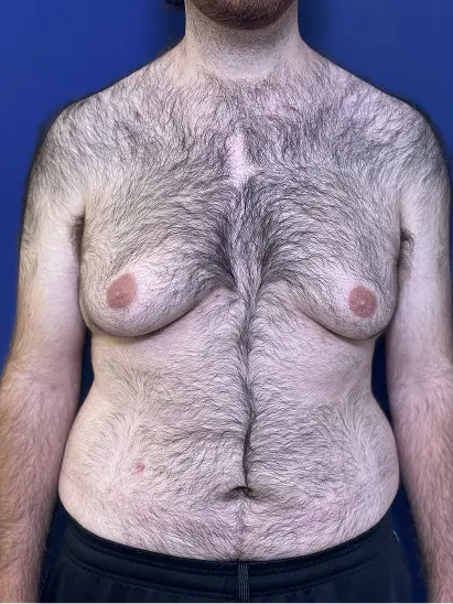 ginecomastia A